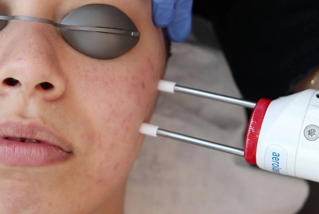 laser acne treatment2