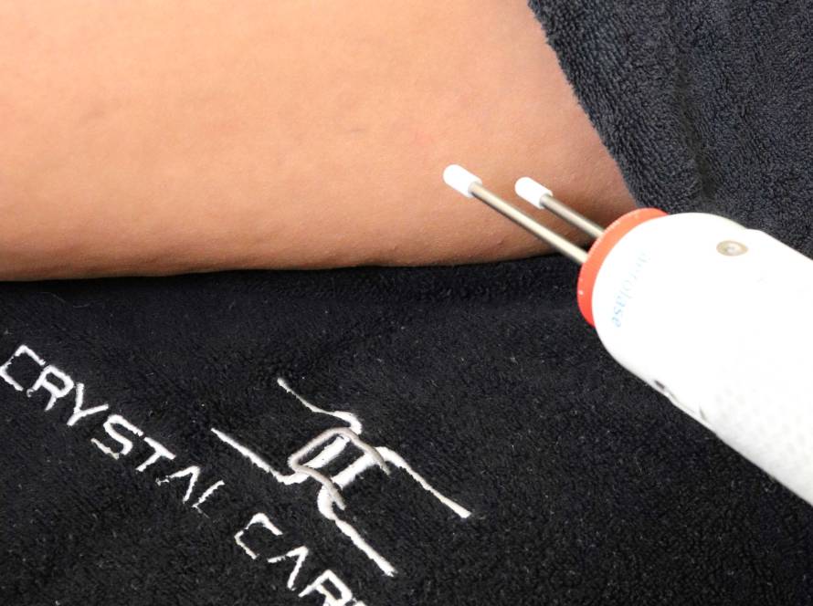 leg veins treatment