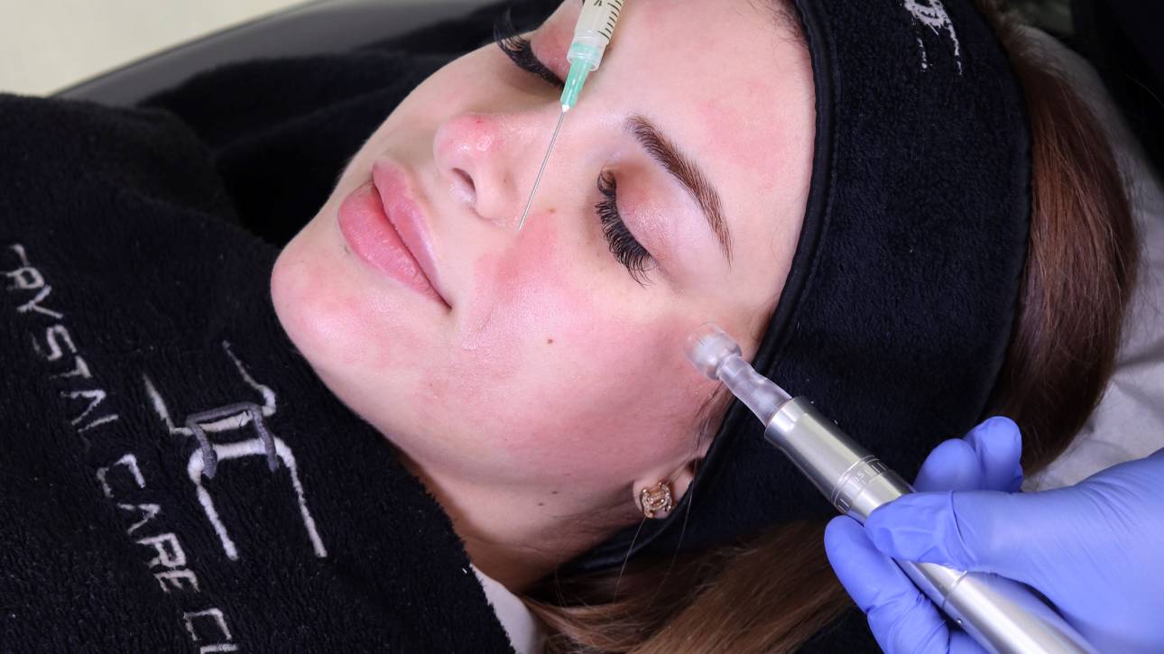 microneedling face treatment