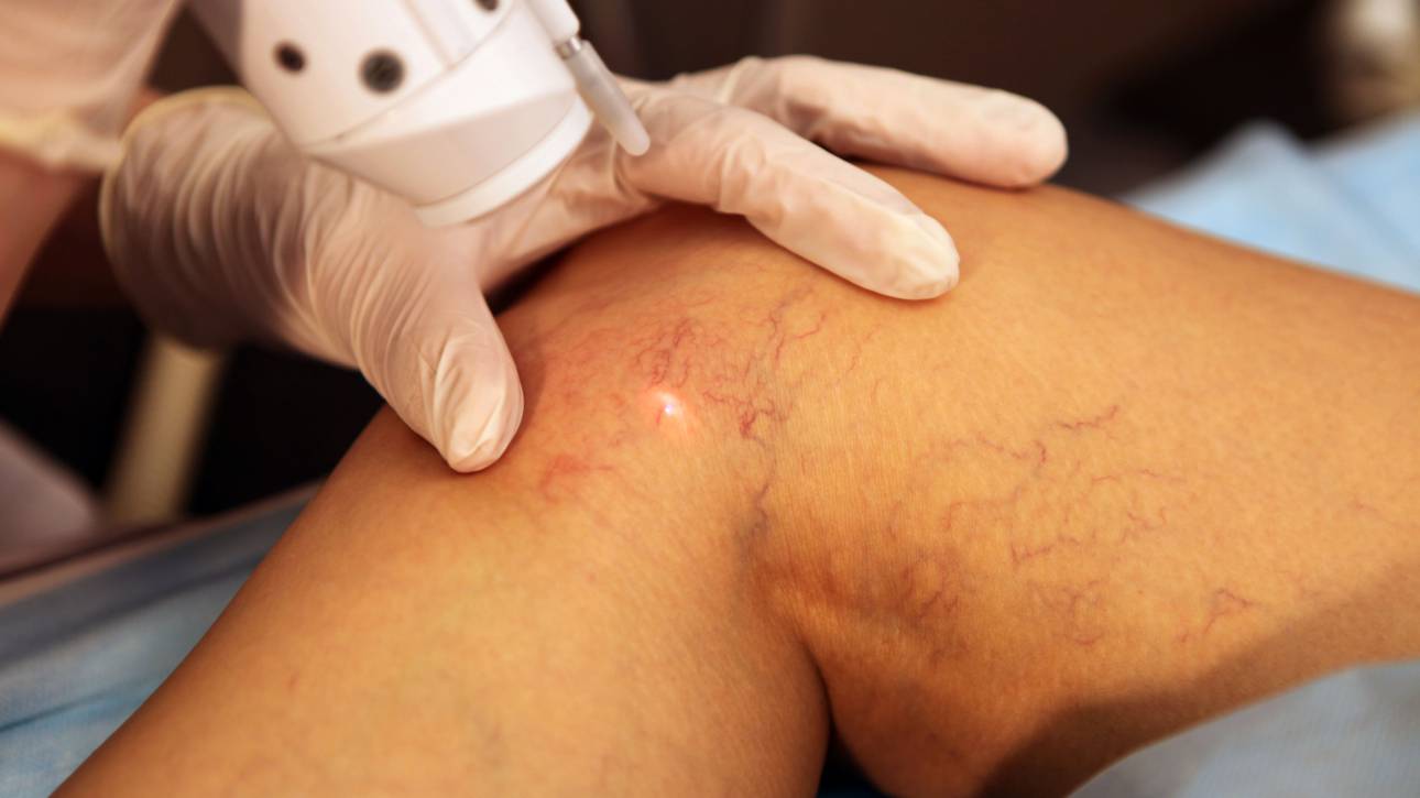 leg veins treatment2