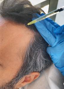 prp hair loss treatment3