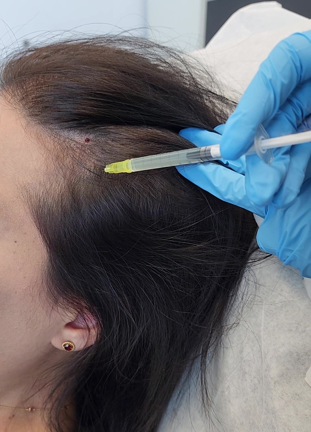 PRP Hair Loss Treatment Crystal Care Clinic