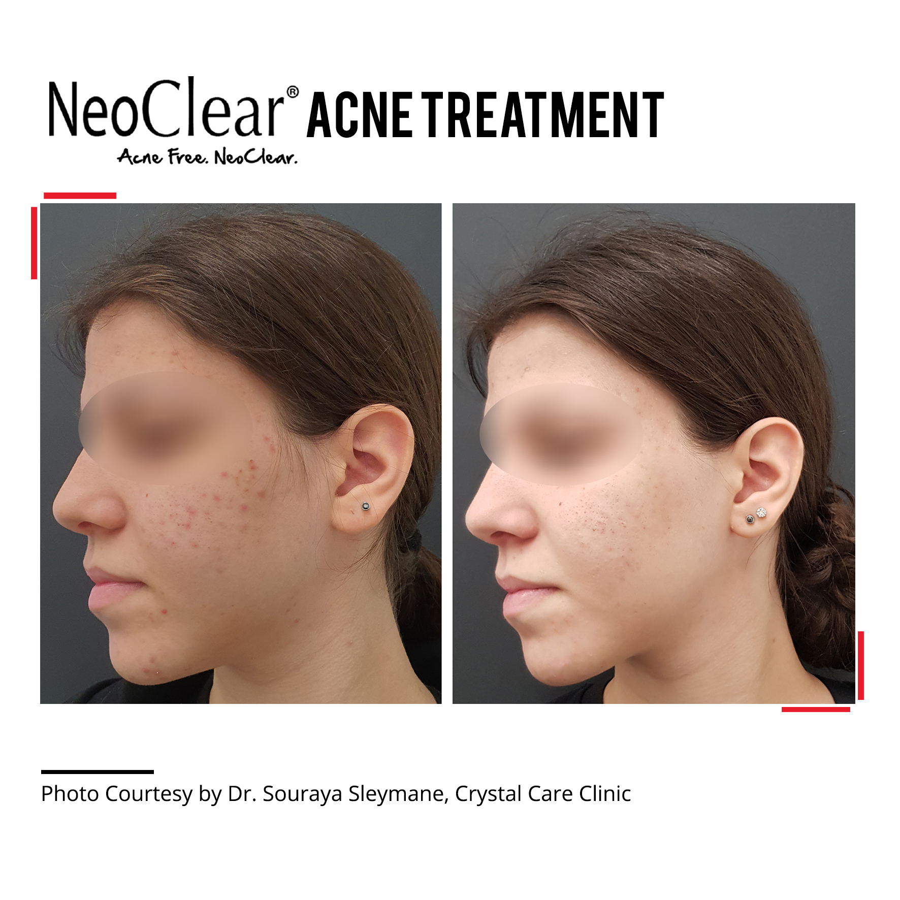 Laser Active Acne Treatment Crystal Care Clinic