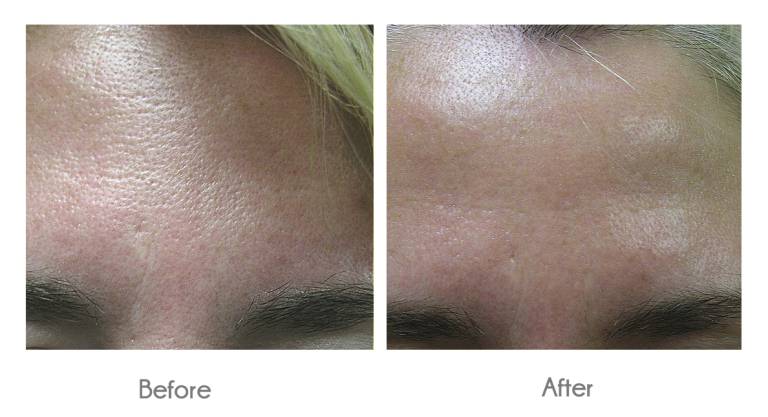 large pores treatment2
