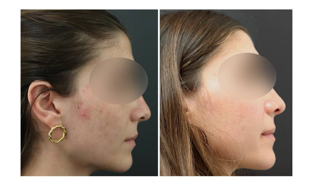 acne scar removal2