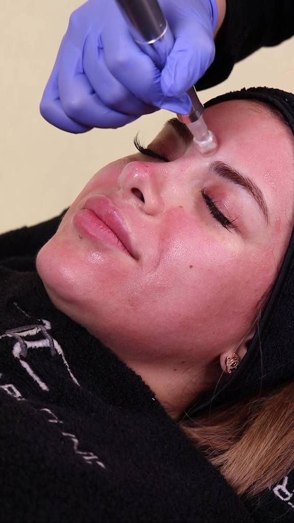 microneedling face treatment