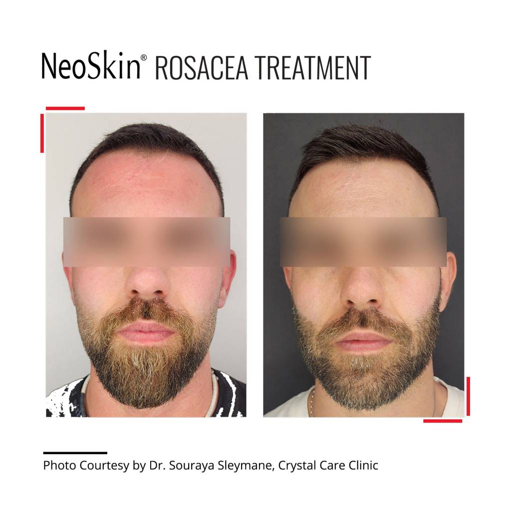 Laser treatment for rosacea near me