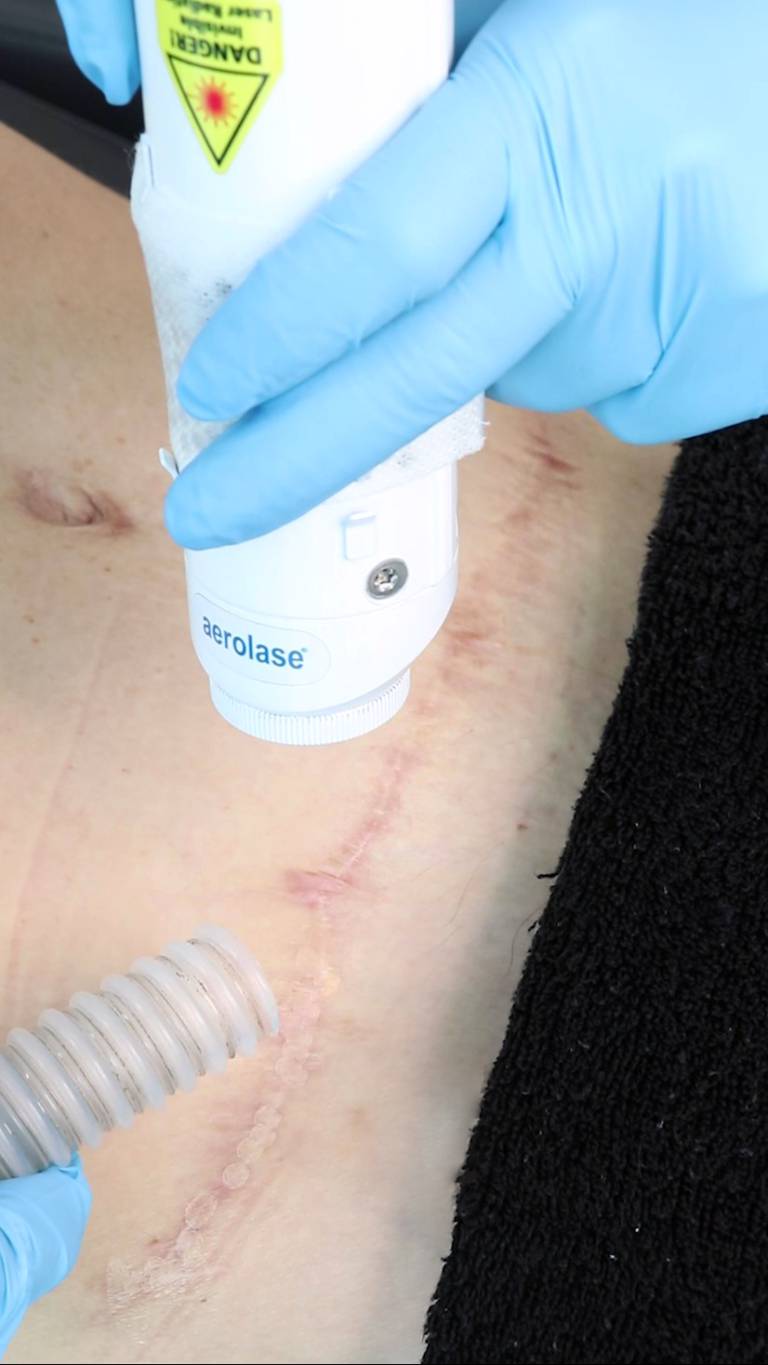 scar removal1